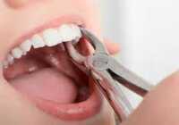 عکس قبل از کشیدن دندان راه های بند آوردن خون را بخوان