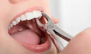 عکس, قبل از کشیدن دندان راه های بند آوردن خون را بخوان