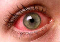 عکس درمان های دارویی آلرژی چشم و نکات لازم درمانی