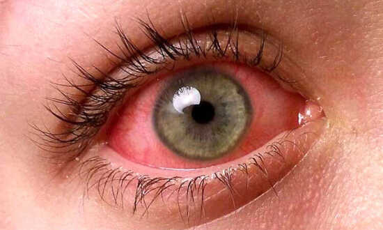 عکس, درمان های دارویی آلرژی چشم و نکات لازم درمانی