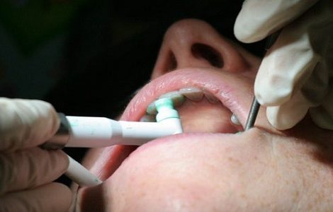 عکس, بررسی تمام روش های جرم گیری دندان ها در مطب
