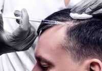 عکس آیا فیلر مو از روش کاشتن موها بهتر است