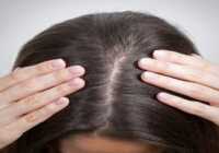 عکس داروها و درمان سنتی افزایش تراکم جلوی مو در زنان و مردان