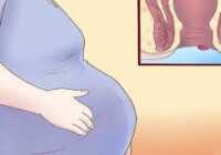 عکس بیرون زدن بواسیر در حاملگی و درمان آن