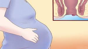 عکس, بیرون زدن بواسیر در حاملگی و درمان آن