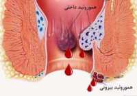 عکس درمان خونریزی بواسیر یا بواسیر خونی و میزان خطر آن