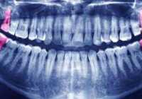 عکس تاثیر کشیدن دندانهای عقل در مرتب شدن دندان های کج