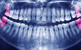 عکس, تاثیر کشیدن دندانهای عقل در مرتب شدن دندان های کج