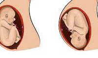 عکس حرکت مخصوص برای چرخیدن سر جنین در هفته های آخر