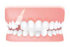 عکس, منظور از دندان نهفته و درمان های آن