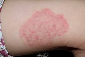 عکس, درمان لکه های قرمز روی پوست بر اثر آلرژی