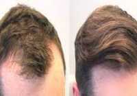 عکس فیناستراید فقط موثر بر ریزش مو بخاطر زیاد بودن هورمون DHT
