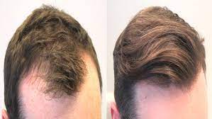 عکس, فیناستراید فقط موثر بر ریزش مو بخاطر زیاد بودن هورمون DHT