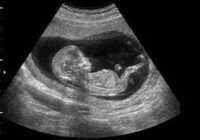 عکس تاثیر زیاد سونوگرافی رفتن در بارداری و زردی نوزاد