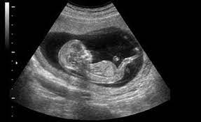 عکس, تاثیر زیاد سونوگرافی رفتن در بارداری و زردی نوزاد