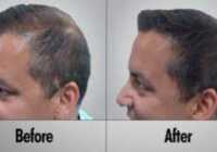 عکس درمان ریزش موی ارثی و هورمونی فقط با ماینوکسیدیل و فیناستراید