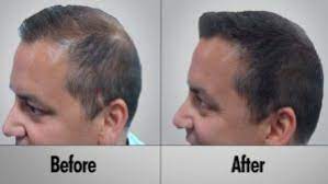 عکس, درمان ریزش موی ارثی و هورمونی فقط با ماینوکسیدیل و فیناستراید