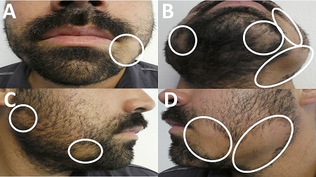 عکس, تمام علت ها و درمان های ریزش ریش در مردان