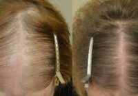 عکس تاثیر فیناستراید در ریزش موی زنان بالای پنجاه سال