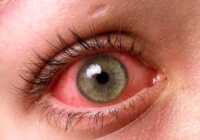 عکس درمان قرمزی چشم ناشی از کرونا یا عوامل دیگر
