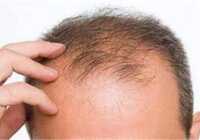 عکس درمان ریزش مو بخاطر حرارت سر و سودای زیاد