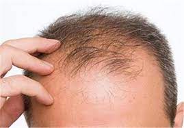 عکس, درمان ریزش مو بخاطر حرارت سر و سودای زیاد