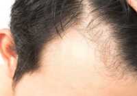 عکس درمان ریزش موی مردان با روشهایی قدرتمند تر از روش سنتی