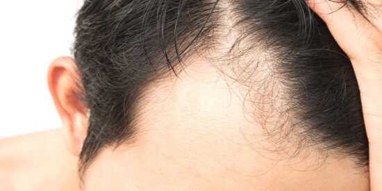 عکس, درمان ریزش موی مردان با روشهایی قدرتمند تر از روش سنتی