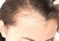 عکس درمان قطعی ریزش مو بخاطر استرس و اعصاب ضعیف