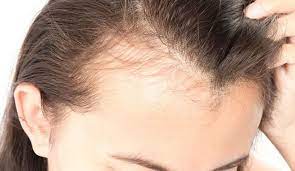 عکس, درمان قطعی ریزش مو بخاطر استرس و اعصاب ضعیف