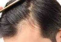 عکس درمان سنتی ریزش مو بخاطر تنگی روزنه مو