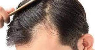 عکس, درمان سنتی ریزش مو بخاطر تنگی روزنه مو