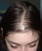 عکس, نسخه سنتی درمان ریزش موی دختران نوجوان و ازدواج نکرده