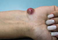 عکس اسم کیست ایجاد شده روی انگشت و مچ دست یا مچ پا یا کف پا