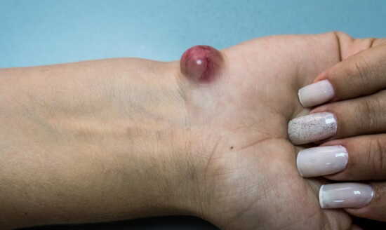 عکس, اسم کیست ایجاد شده روی انگشت و مچ دست یا مچ پا یا کف پا