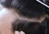 عکس درمان سنتی شوره و ریزش مو بخاطر خشکی سر