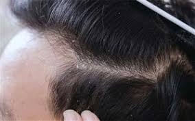 عکس, درمان سنتی شوره و ریزش مو بخاطر خشکی سر