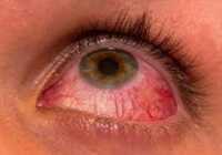 عکس داروی گیاهی و بی خطر برای محو قرمزی چشم