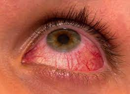 عکس, داروی گیاهی و بی خطر برای محو قرمزی چشم
