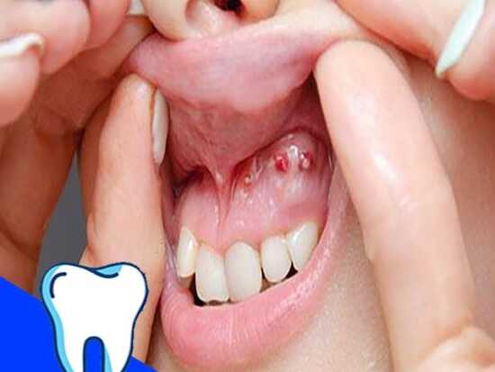 عکس, ارزان ترین درمان های کیست دندان