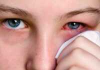 عکس سریع ترین درمان های برق زدگی چشم در خانه