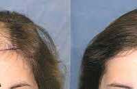 عکس آیا برای کاشت مو زنان نیز باید موهای خود را بتراشند