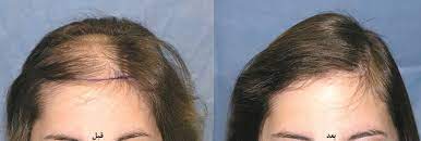 عکس, آیا برای کاشت مو زنان نیز باید موهای خود را بتراشند