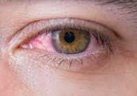 عکس علائم آلرژی چشم و اسم داروهای آن
