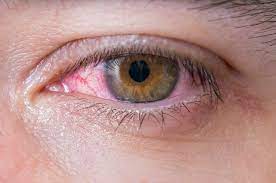 عکس, علائم آلرژی چشم و اسم داروهای آن