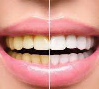 عکس, ارزان ترین و فوری ترین راه سفید شدن دندانها