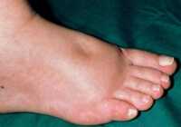 عکس عکس ورم پا و تغییر رنگ آن که نشانه بیماری قلبی است
