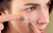 عکس, درمان جوش های غیر التهابی صورت همراه با عکس