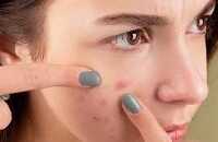 عکس درمان جوش های غیر التهابی صورت همراه با عکس