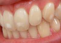 عکس علت و درمان لکه های سفید روی دندان